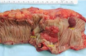 cancer de colon operacion